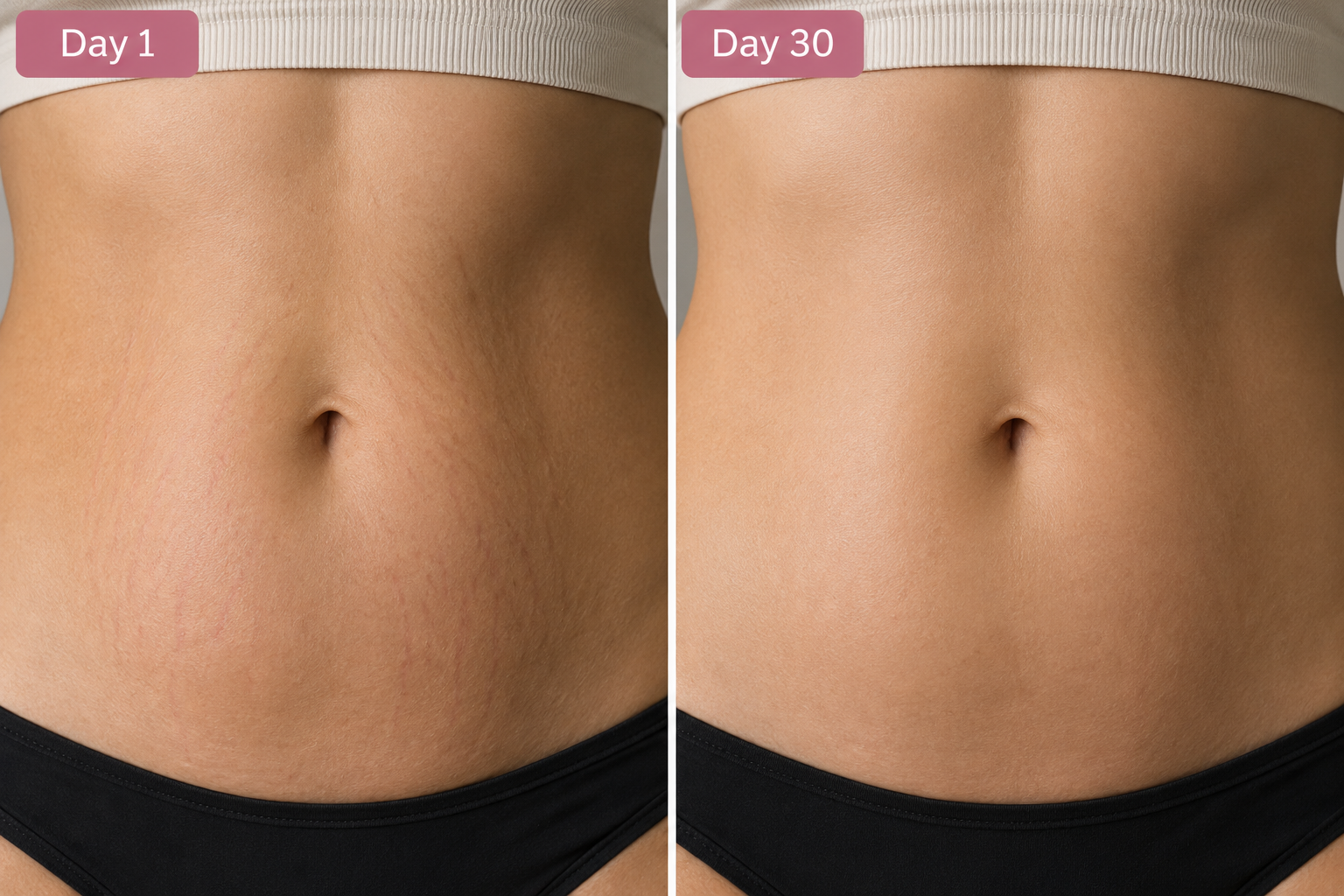 Stretch Mark Cream